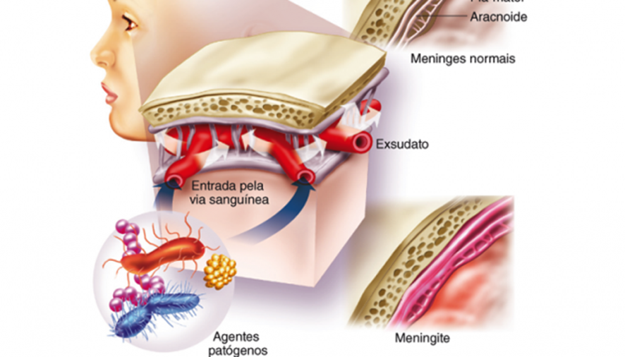 Doenças infecciosas e parasitárias: meningite virais e bacterianas
