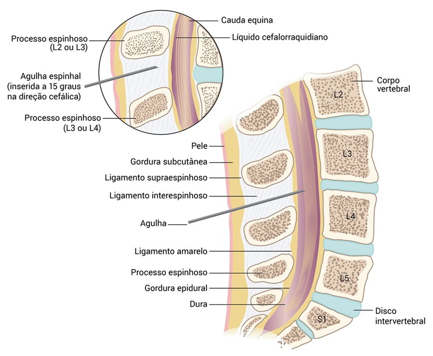 O líquor circula pelos ventrículos após sua produção no plexo coroide, atingindo, a partir do quarto ventrículo, sua circulação externa no espaço suba- racnoide. Este é o espaço compreendido entre a pia mater e a aracnoide, composto por trabéculas de tecido conjuntivo (com aspecto de teia de aranha, daí o nome da membrana), vasos e artérias. A aquisição do líquor pode ser realizada através de procedimento relativamente simples, chamado punção liquórica, no qual se acessam cisternas, que são dilatações do espaço subaracnoide.