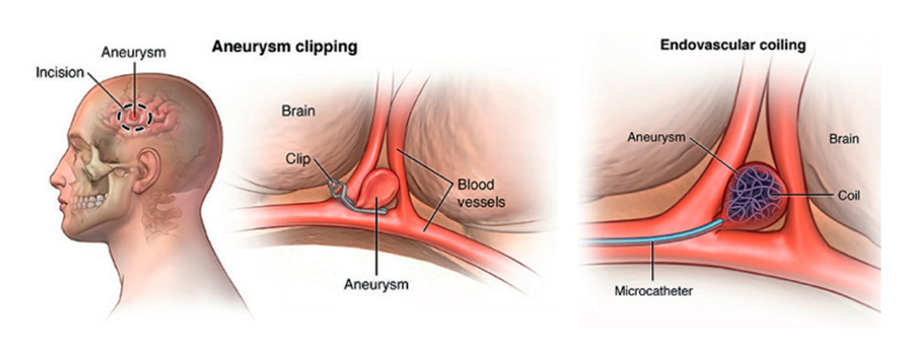 Acidente vascular hemorrágico:  abordagem precoce do aneurisma roto demonstrou redução importante no risco de ressangramento e de vasoespasmo, consequentemente reduzindo a mortalidade nestes pacientes