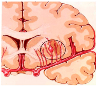 Acidente encefálico Hemorrágico : microaneurismas que podem ocorrer em arteríolas intracerebrais